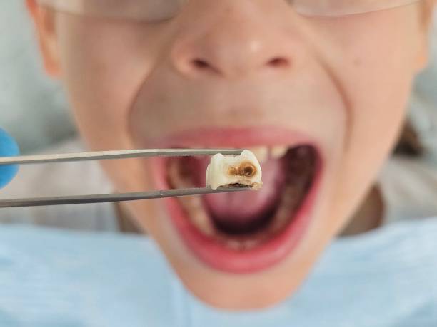 Best Emergency Root Canal Therapy in Hamlin, WV