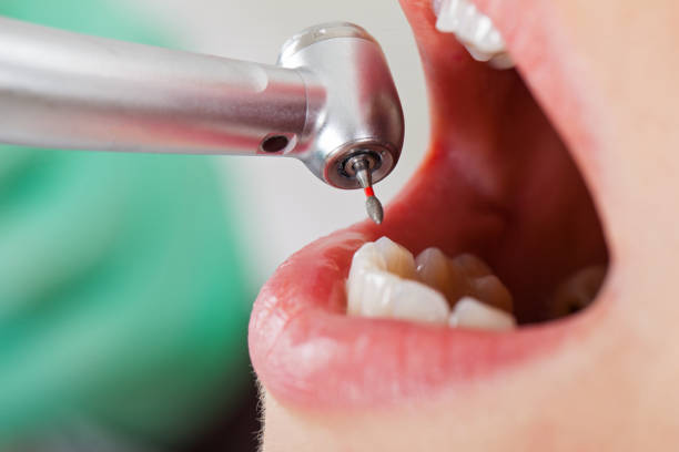 Best Knocked-Out Tooth (Avulsed Tooth) Treatment in Hamlin, WV